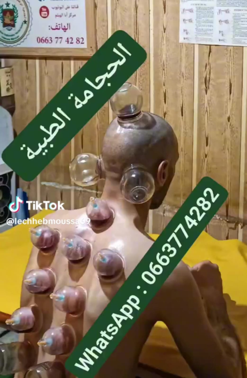 الحجامة هدية من رب العالمين للإنسانية جمعاء