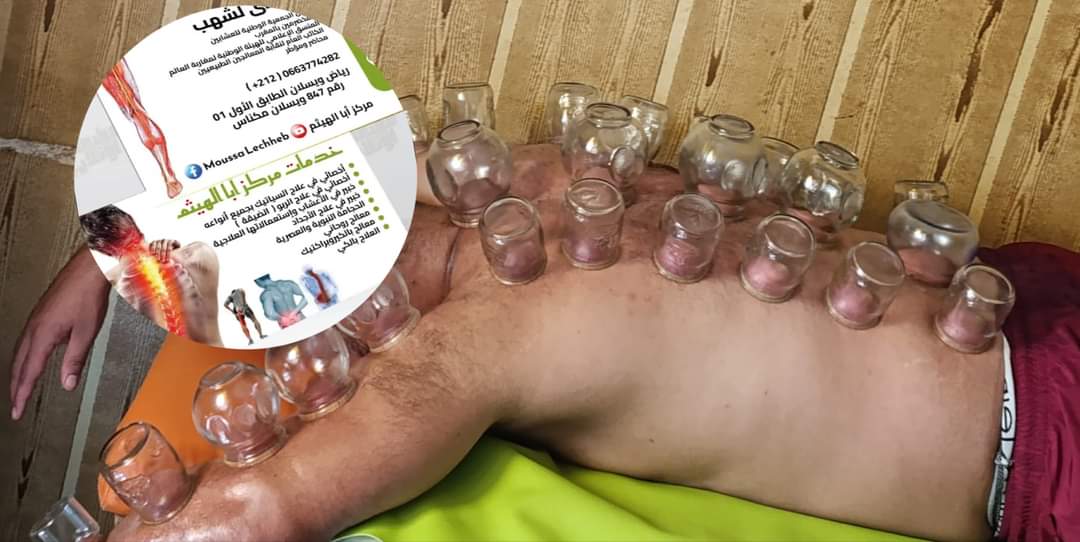 ****** دم الحجامة ****** ****** دم الحجامة ******